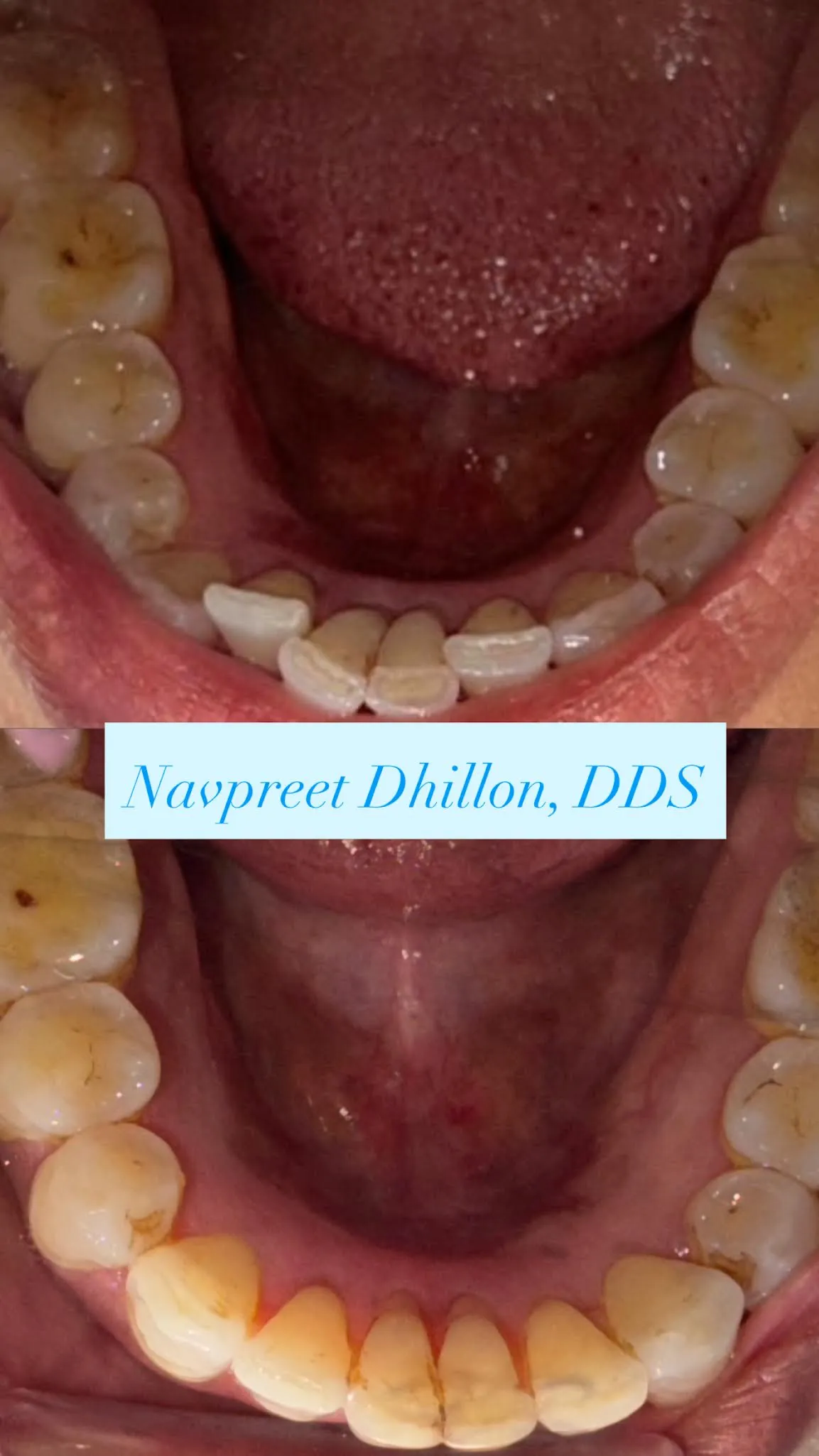 Invisalign Effect